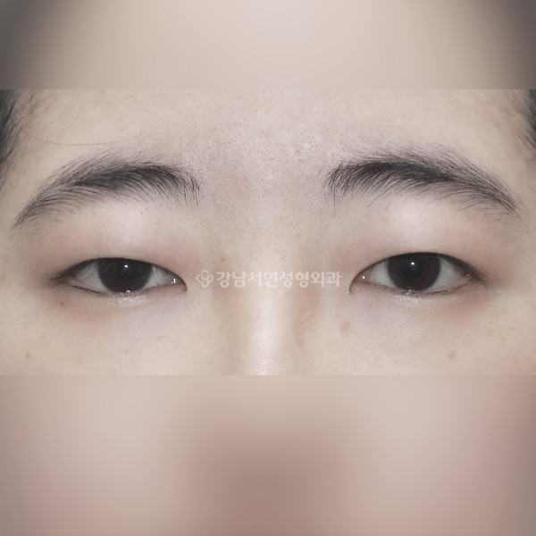 절개쌍꺼풀+앞트임 BEFORE