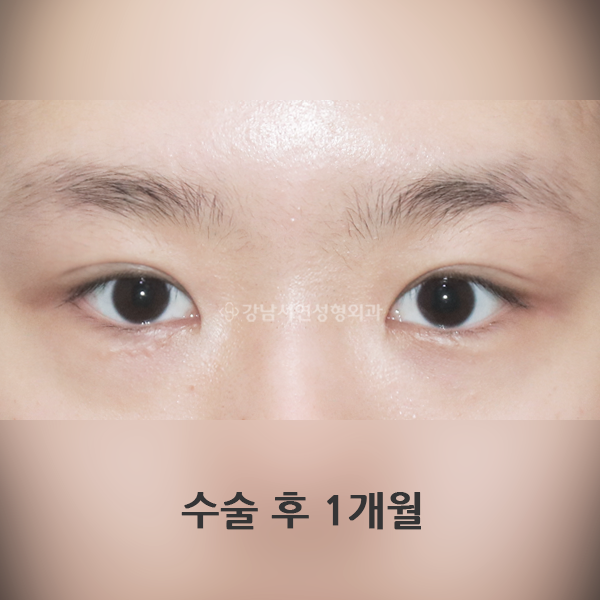 매몰쌍꺼풀+앞트임 AFTER