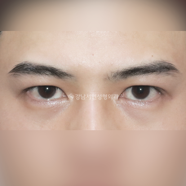 비대칭교정 재수술 BEFORE