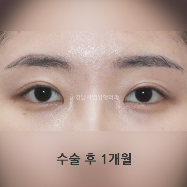 쌍꺼풀 재수술 AFTER