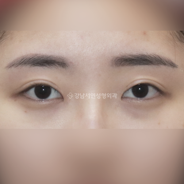 쌍꺼풀 재수술 BEFORE