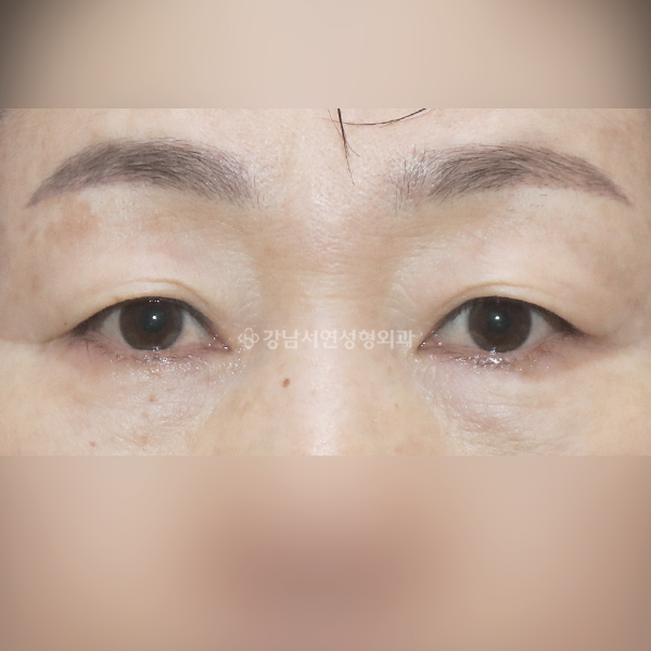 상안검 BEFORE