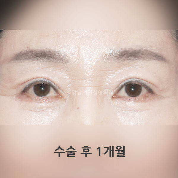 상안검 AFTER