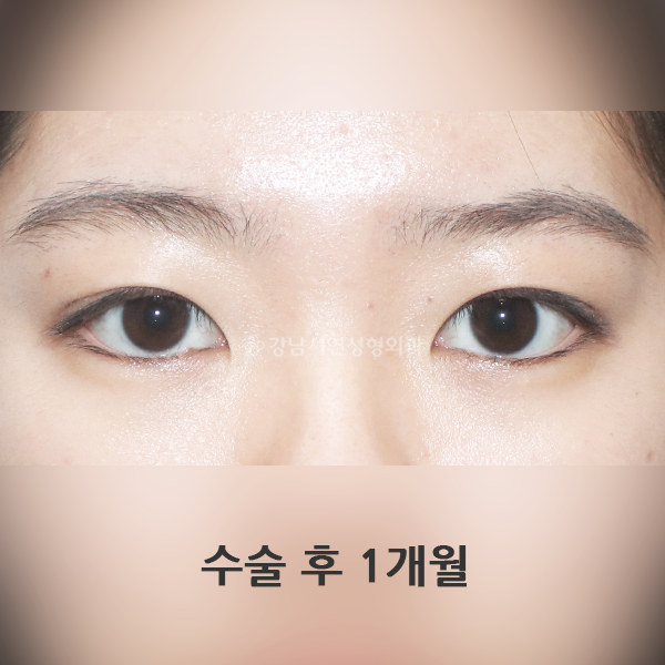 매몰 쌍꺼풀 AFTER