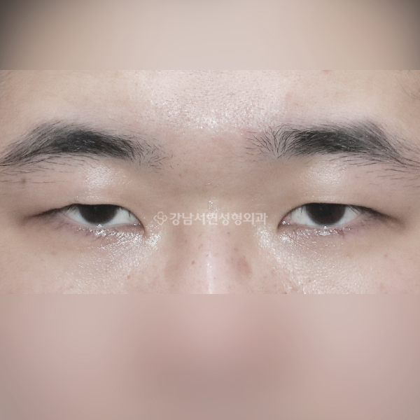 남자 무쌍눈매교정 BEFORE
