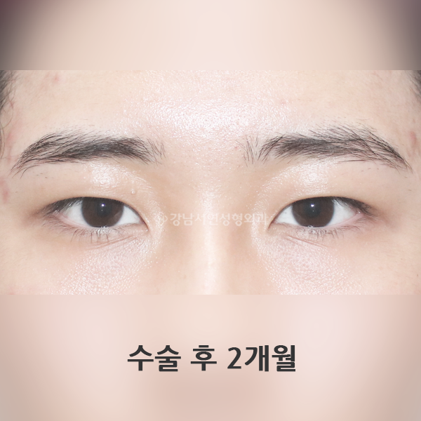 남자 무쌍눈매교정 AFTER