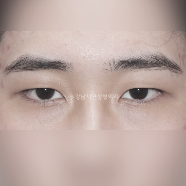 남자 무쌍눈매교정 BEFORE