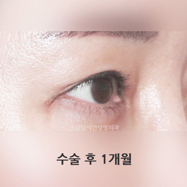뒤트임 복원 AFTER