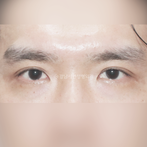 무쌍눈매교정, 쌍꺼풀 없애기 BEFORE