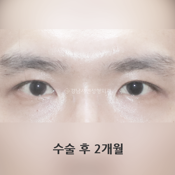 무쌍눈매교정, 쌍꺼풀 없애기 AFTER