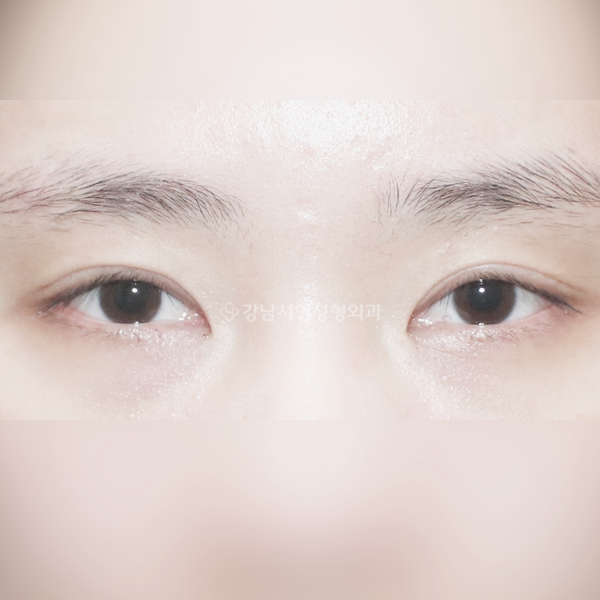 겹주름 개선 AFTER
