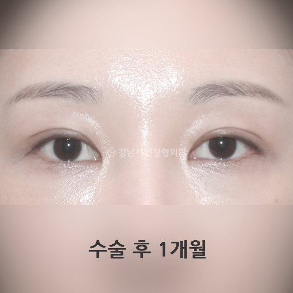 절개 쌍꺼풀 재수술 AFTER