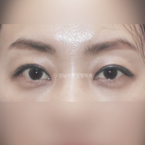 절개 쌍꺼풀 AFTER
