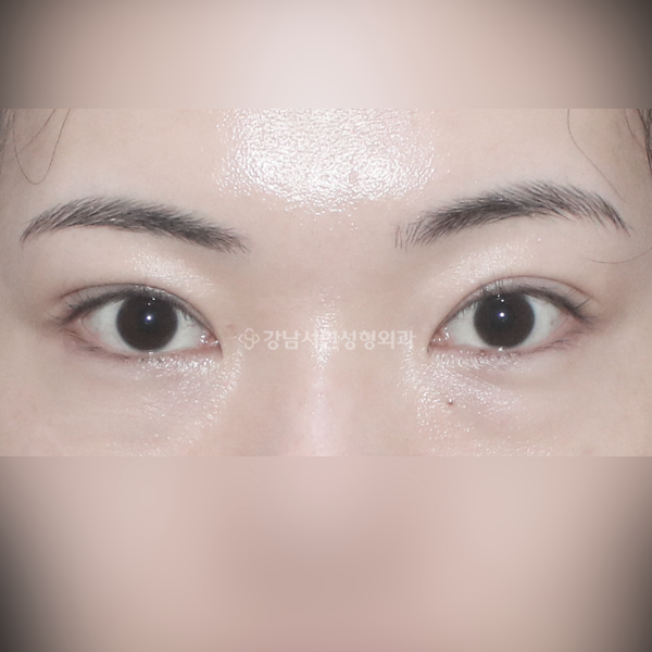쌍꺼풀 재수술 라인교정 AFTER