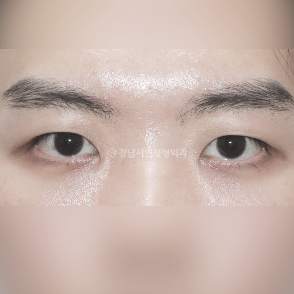 남자 무쌍눈매교정 AFTER