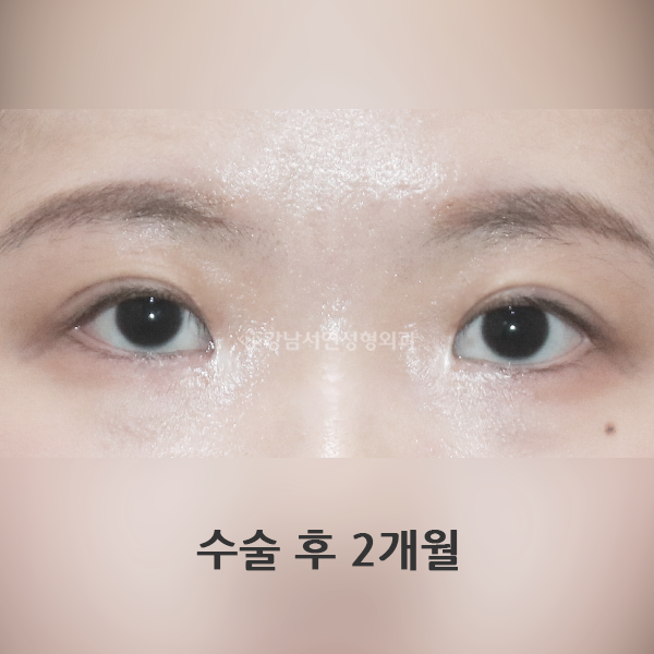 퇴축수술 짝눈교정 AFTER