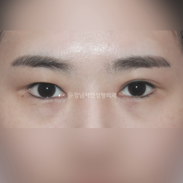 짝눈 교정 BEFORE