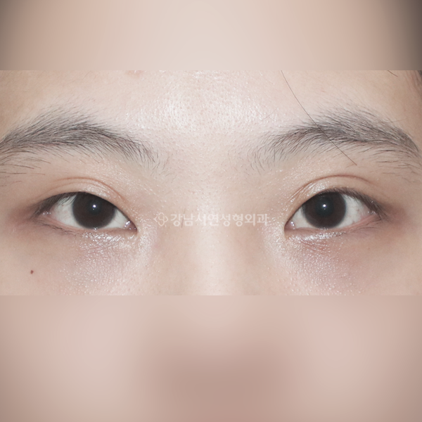 겹주름 교정 BEFORE
