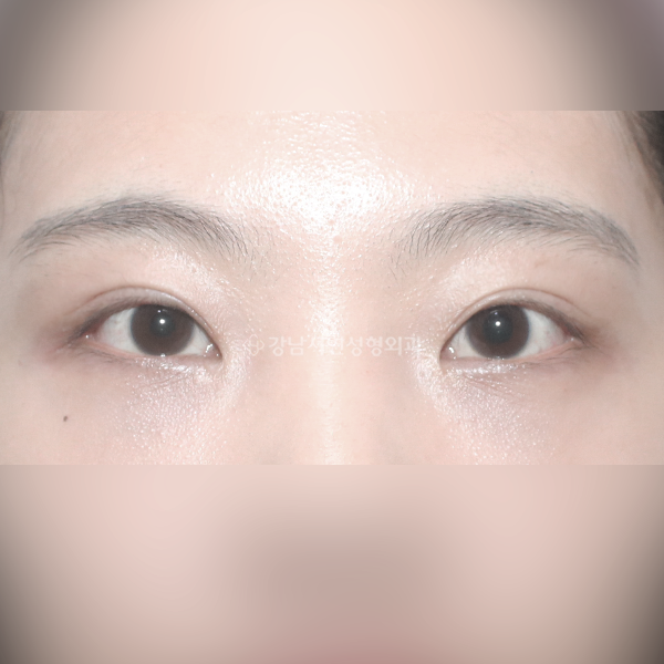 겹주름 교정 AFTER