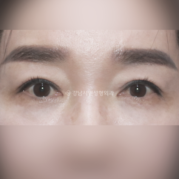 상안검 AFTER