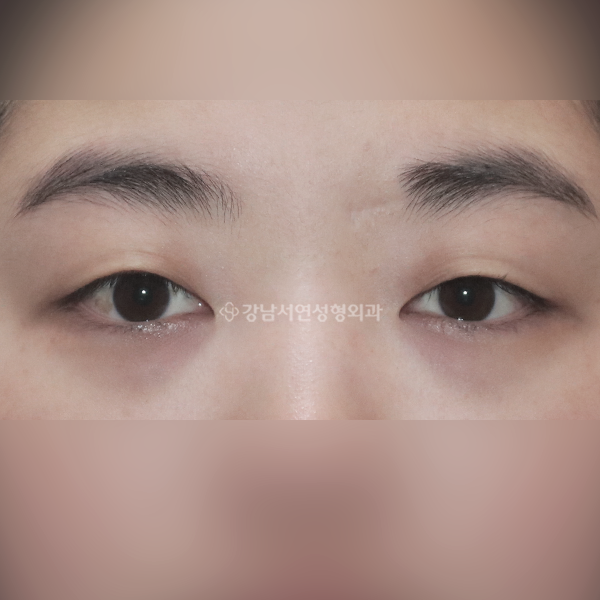 절개 쌍꺼풀 BEFORE