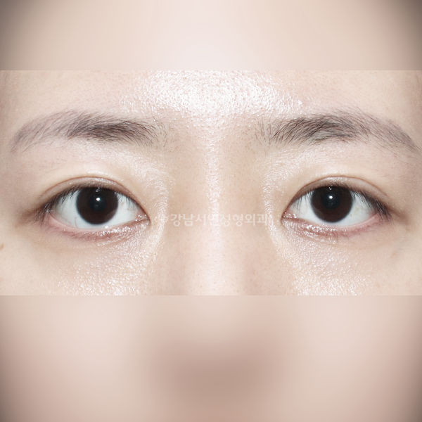 두줄따기 라인낮추기 AFTER