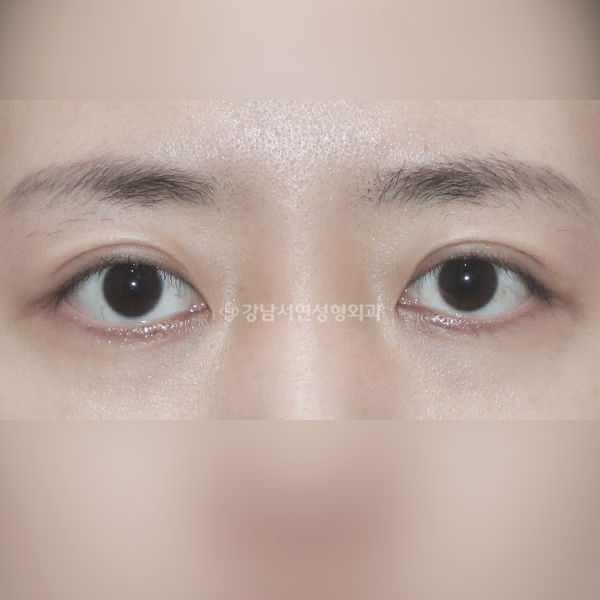 두줄따기 라인낮추기 BEFORE
