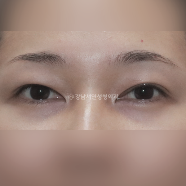상안검 BEFORE