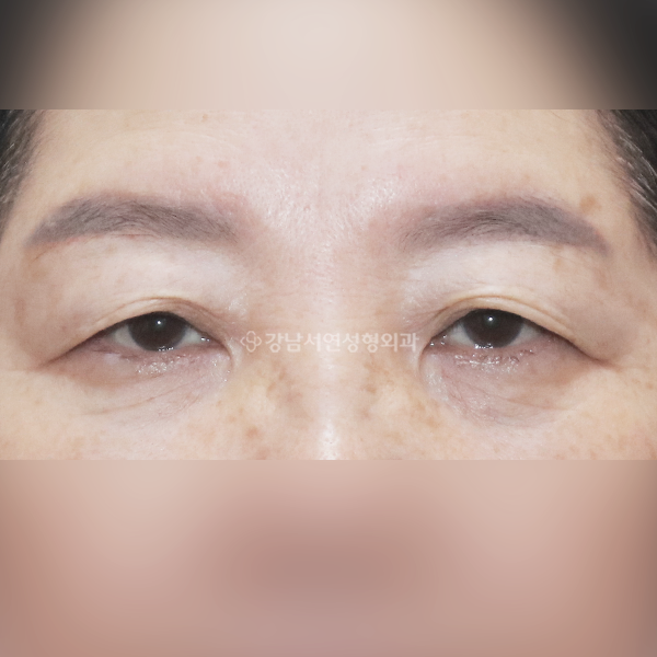 노인성 상안검 BEFORE