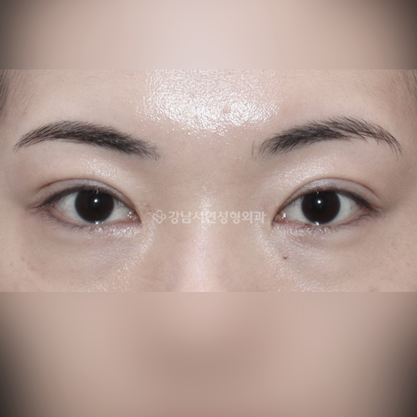 쌍꺼풀 재수술 라인정리 AFTER