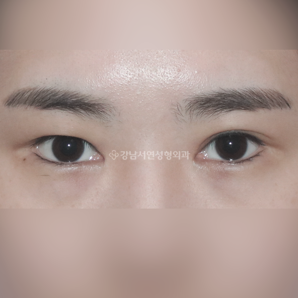 쌍꺼풀 비대칭 교청 BEFORE