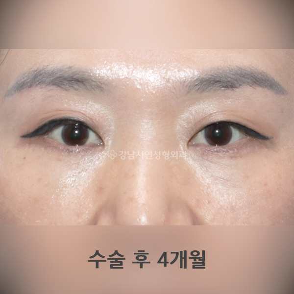 하안검 수술 AFTER