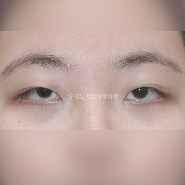 절개눈매교정+앞트임 BEFORE