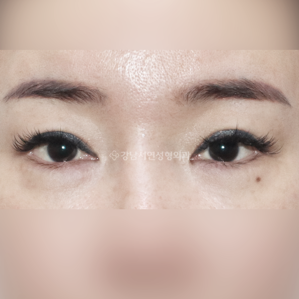 밑트임 AFTER