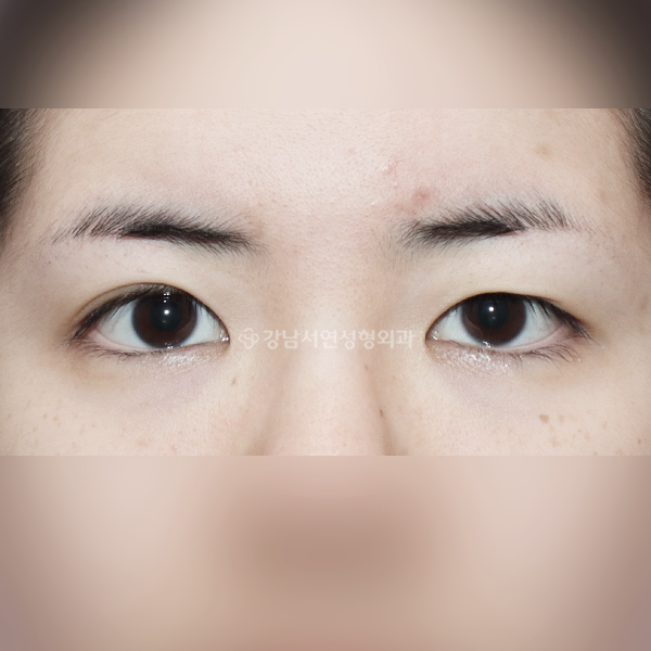 매몰 쌍꺼풀 재수술 BEFORE