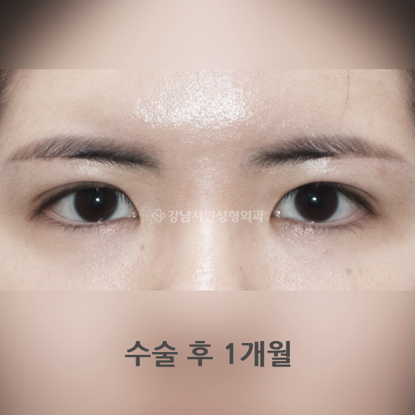 매몰 쌍꺼풀 재수술 AFTER