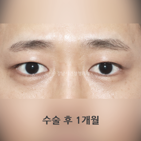 남자 무쌍(속쌍)눈매교정 AFTER