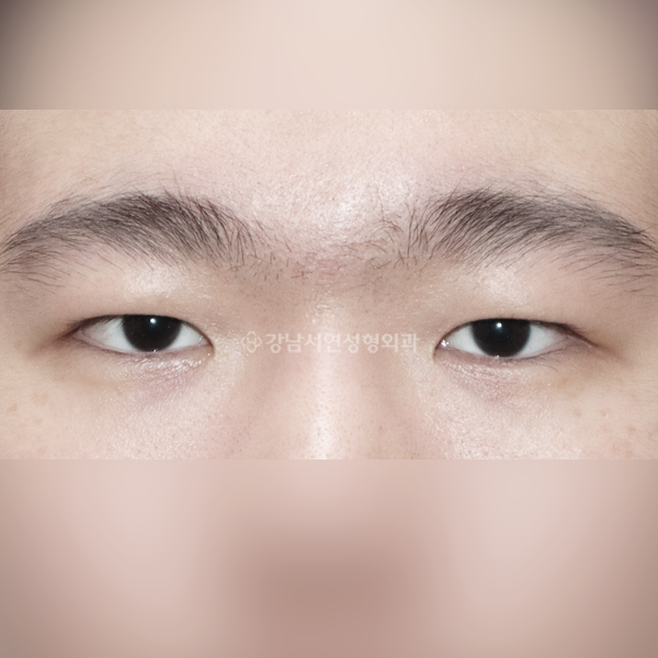 남자 무쌍눈매교정 AFTER