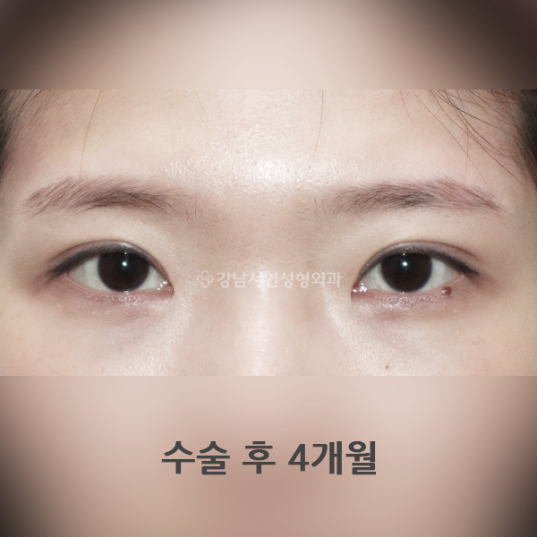 절개눈매교정 과교정 조기교정(눈당김 개선) AFTER