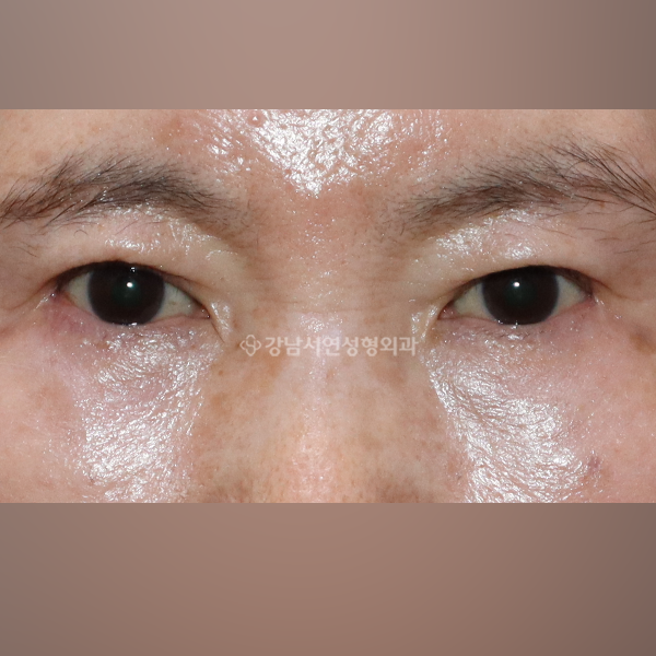 눈밑지방재배치 + 하안검 AFTER
