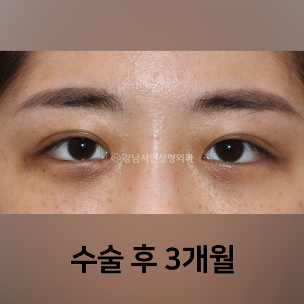 절개쌍꺼풀 + 앞트임 AFTER