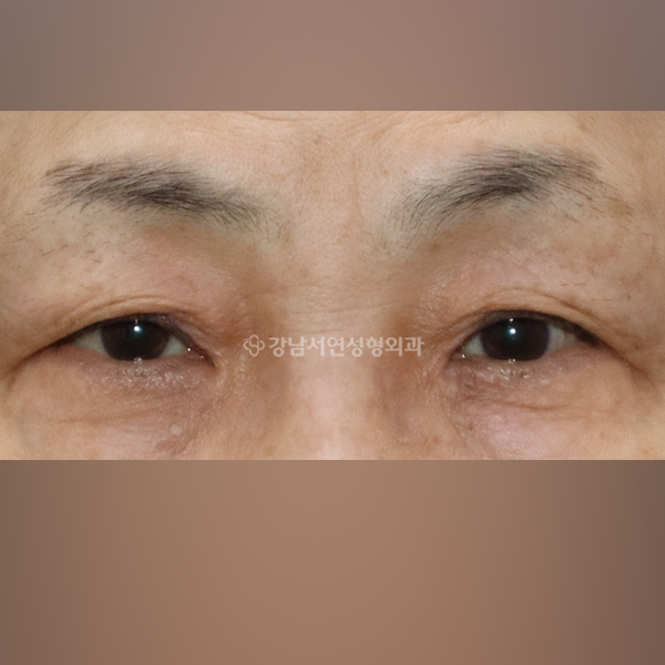 노인성 상안검 BEFORE