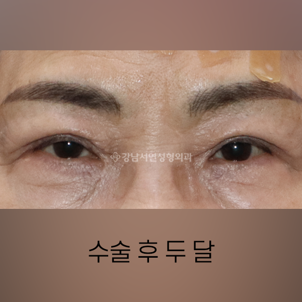 노인성 상안검 AFTER