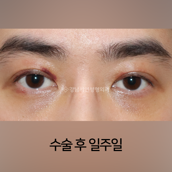 비대칭 눈매교정 AFTER