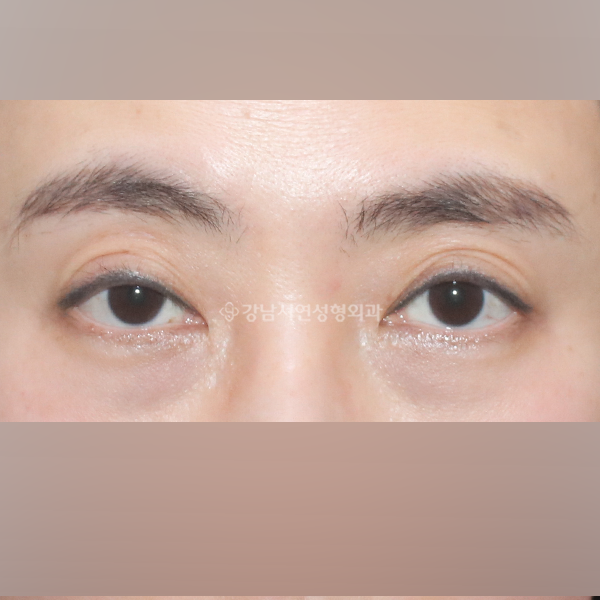 심한 겹주름 + 극한눈 절개눈매교정 재수술 BEFORE
