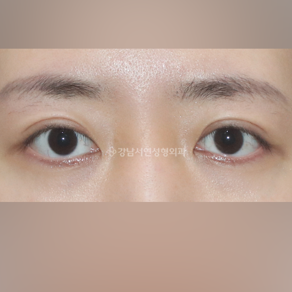 두줄따기 BEFORE