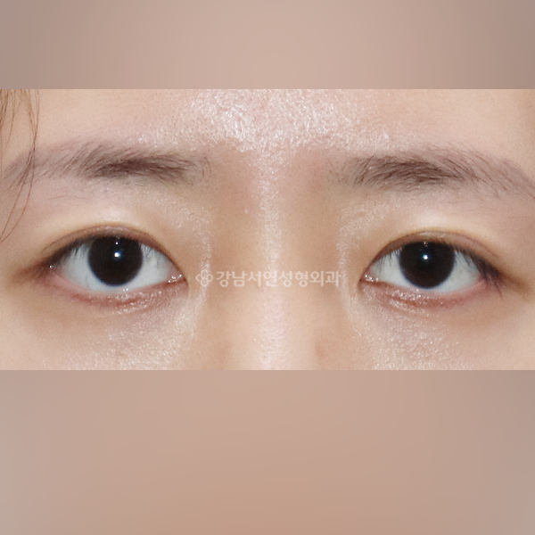 두줄따기 AFTER