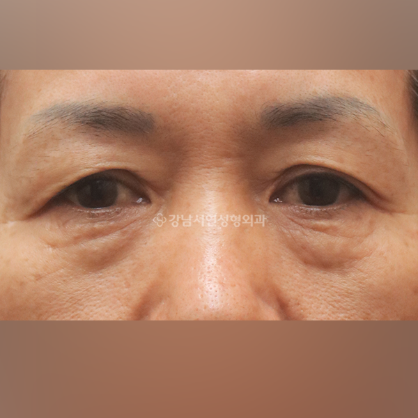 상안검+하안검 BEFORE