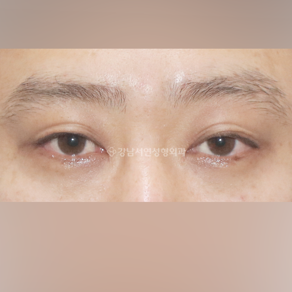 남자 쌍꺼풀 감추기 BEFORE