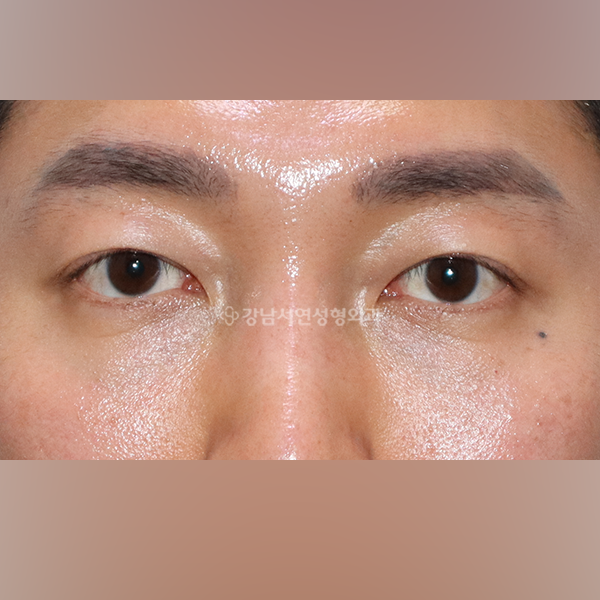 비대칭 절개눈매교정 + 눈밑지방재배치 AFTER